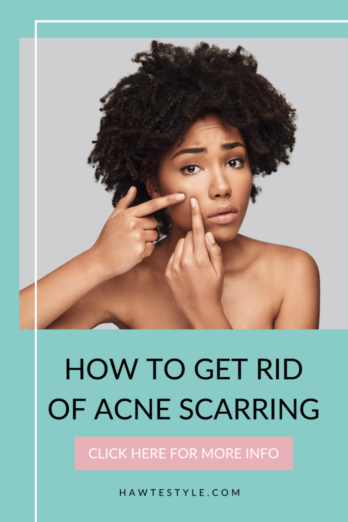 HOW TO GET RID OF ACNE SCARRING